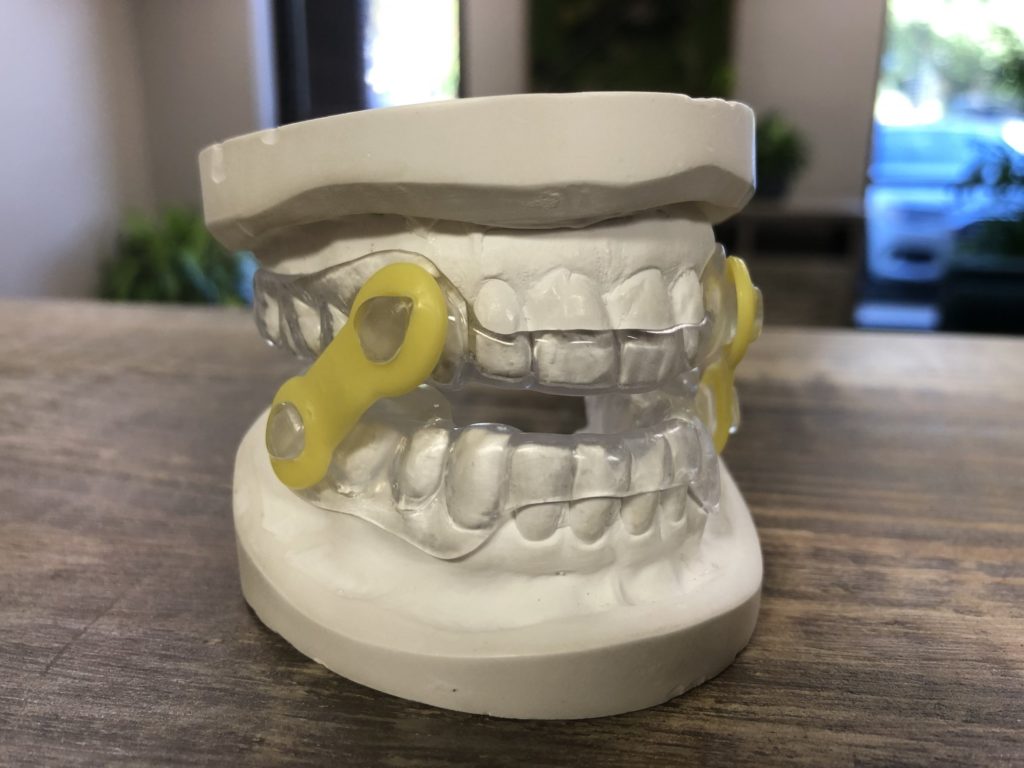 Night Guards Bay Area TMJ and Sleep Center