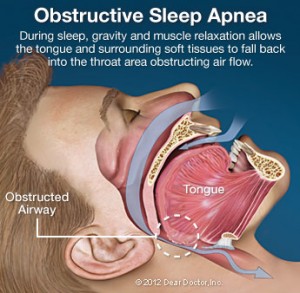 obstructive sleep apnea